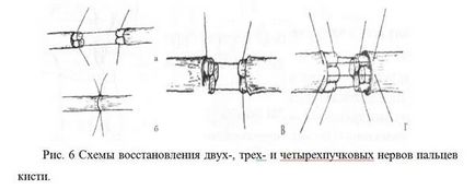 Операції на нервах кисті, травматологія для всіх