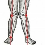 Ортез для колінного суглоба - які бувають і для чого потрібні