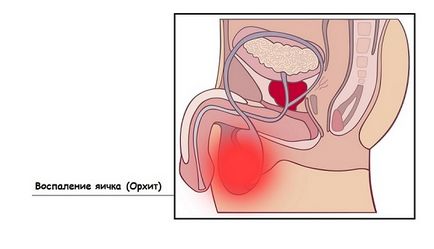 Simptomele orhitei și tratamentul unui testicul afectat la bărbați