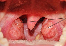 Про симптоми і лікування хронічного тонзиліту та ангіни