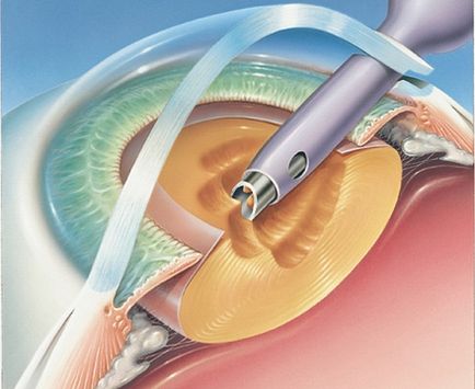 Complicații ale chirurgiei cataractei