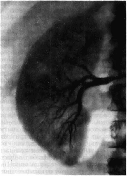 Caracteristicile diagnosticului cu raze X a tumorilor sistemului urinar - oncologie generală