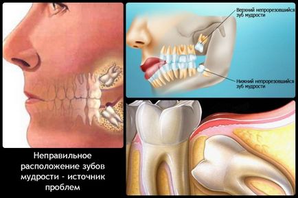 Caracteristicile dinților de înțelepciune, merită să le ștergeți