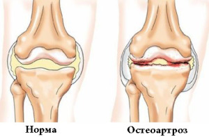 Остеоартроз колінного суглоба