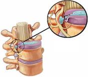 Osteocondroză, simptome de osteocondroză, prevenirea osteochondrozelor