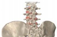 Osteocondroză, simptome de osteocondroză, prevenirea osteochondrozelor