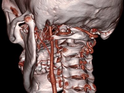 Accident vascular cerebral accidental de tip ischemic