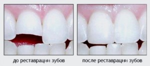 Відколовся шматочок металокерамічної коронки