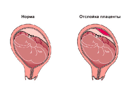 Leválása a petesejt a korai terhesség - tünetei és okai