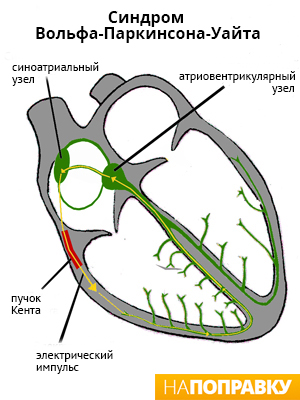 Paroxizmális tachycardia (szapora szívverés) okai, tünetei, kezelése - napopravku