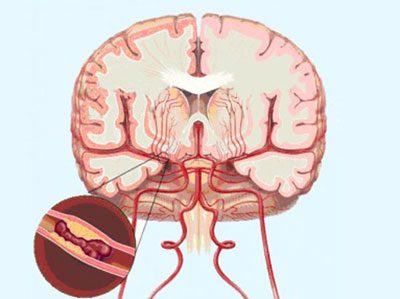 Supradozaj cu simptome și efecte de piracetam