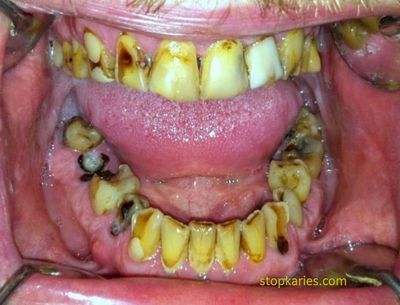 Чому болять зуби від кислого