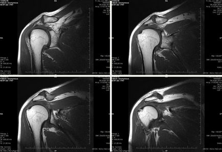 Jelzések az MRI a vállízület és ajánlások elkészítése