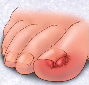 Poliartrita degetelor mâinii și tratamentul poliartritei mâinilor