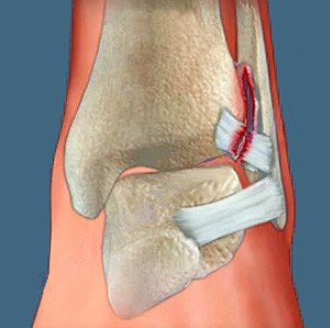 Посттравматичний артроз великого пальця ноги і лучезапястного суглоба