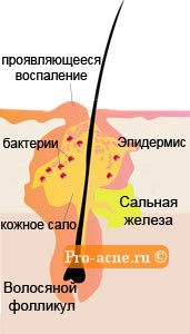 Причини появи акне