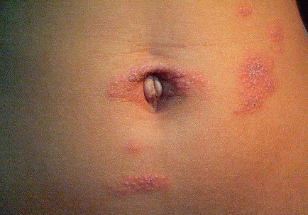 Ознаки цитомегаловірусу (ЦМВ-інфекції) - тепература, висип на шкірі, виділення, кашель