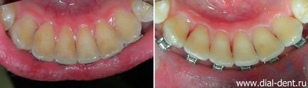 Професійне чищення зубів в період лікування брекетами