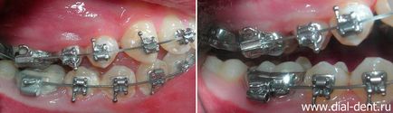 Професійне чищення зубів в період лікування брекетами