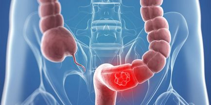 Semne și simptome de cancer intestinal, câte persoane trăiesc