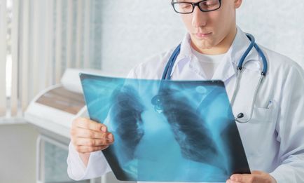 Cancerul pulmonar la o vârstă fragedă la femei tinere cu fumat