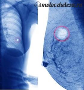 Decolorarea mamografiilor glandelor mamare