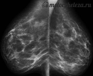 Decolorarea mamografiilor glandelor mamare