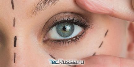 Ochii diferiți după blefaroplastie și asimetria pleoapelor