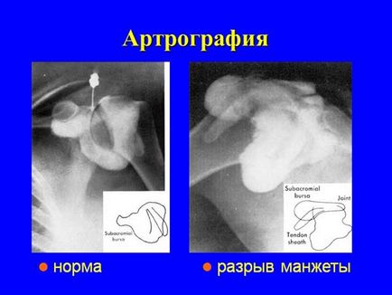 Ruptura manerului rotativ al umărului, traumatologie pentru toți