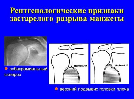 Ruptura manerului rotativ al umărului, traumatologie pentru toți