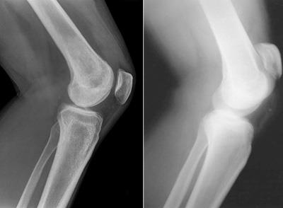 Roentgen al articulațiilor cu artrită