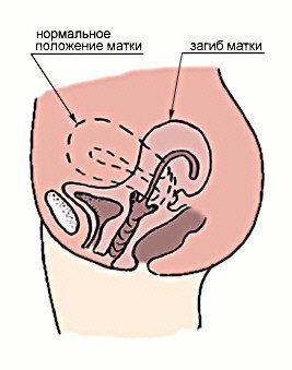 Retroflexia uterului - cauze, simptome, tratament și sarcină