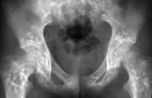 Manifestări reumatologice ale osteopeniei