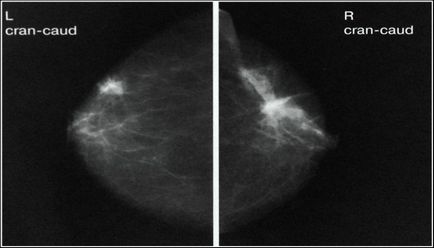 Результати мамографії молочних залоз розшифровка укладення