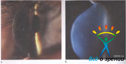 Cornea - # 9474; partea 1