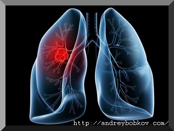 Саркоїдоз легенів лікування - чи можна саркоїдоз вилікувати народними засобами
