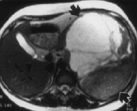 Simptomele și tratamentul tumorilor retroperitoneale extraorganice