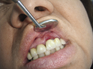 Sclerosing terapie (1 papila) - centrul de medicină estetică dent - îngrijire