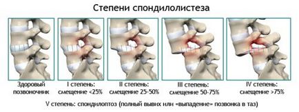 Спондилолистез причини, діагностика, лікування