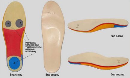Устілки при шпорі п'яти подпяточнікі, взуття, ортопедичні устілки своїми руками, як вибрати