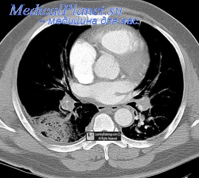 Cursul glomerulonefritei acute