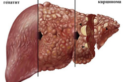 Toxikus hepatitis jelei, tünetei és kezelése, diéta