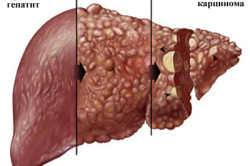 Semne hepatice hepatice, simptome și tratament, dietă