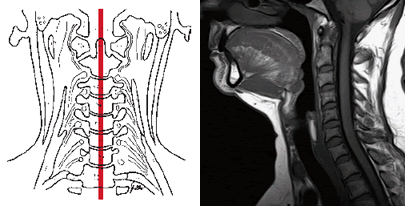 Tratamentul gâtului și tratamentul sindromului cervical-cranial