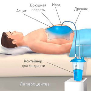 U3i (examinarea cu ultrasunete) pe troeschină, costul lui у3и, uzi al ficatului în troeschina