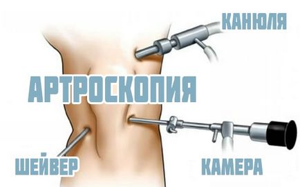 Видалення меніска колінного суглоба