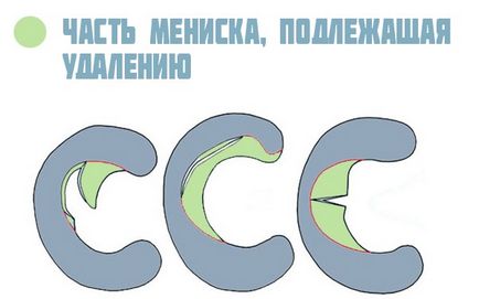 Видалення меніска колінного суглоба