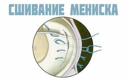 Видалення меніска колінного суглоба