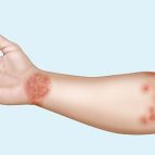 Injecții pentru eczeme - instrucțiuni de utilizare, indicații, caracteristici ale aplicației