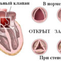 Запечатайте аортната корен